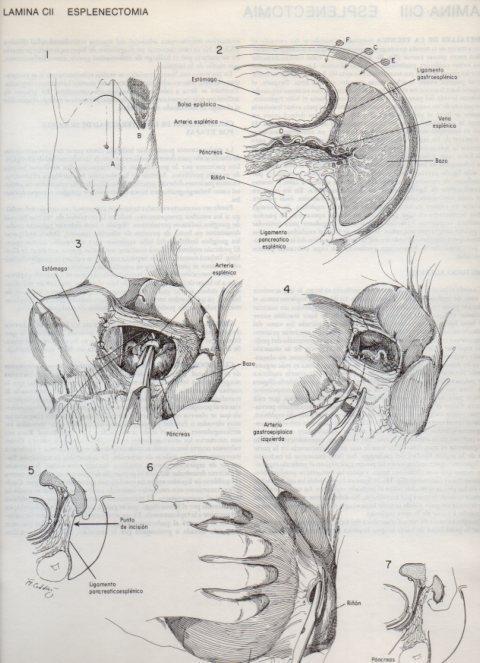 LAMINA V20163: Esplenectomia