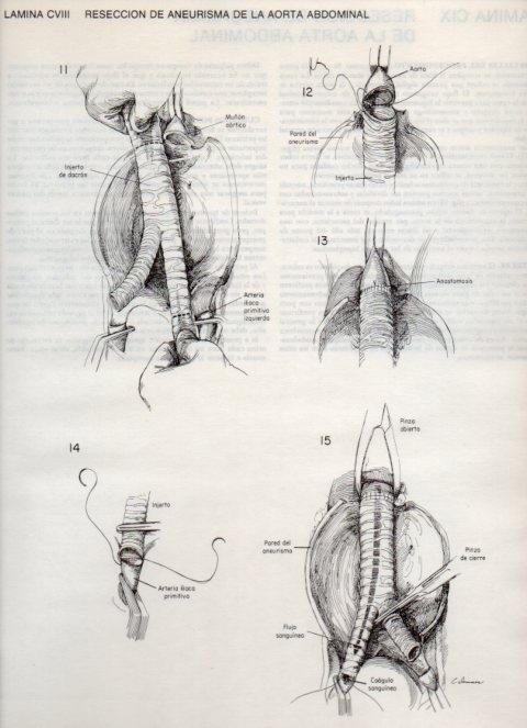 LAMINA V20169: Reseccion de aneurisma de la aorta abdominal 1