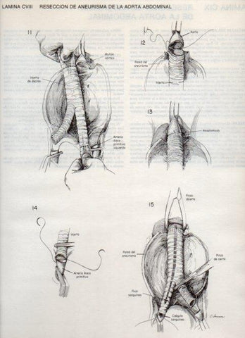LAMINA V20169: Reseccion de aneurisma de la aorta abdominal 1