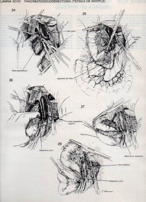 LAMINA V20159: Pancreaticoduodenectomia, tecnica de Whipple 5