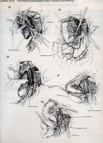 LAMINA V20159: Pancreaticoduodenectomia, tecnica de Whipple 5