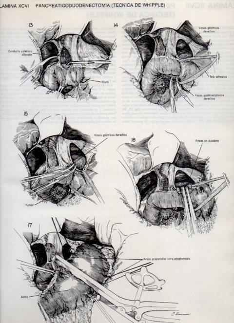 LAMINA V20157: Pancreaticoduodenectomia, tecnica de Whipple 3