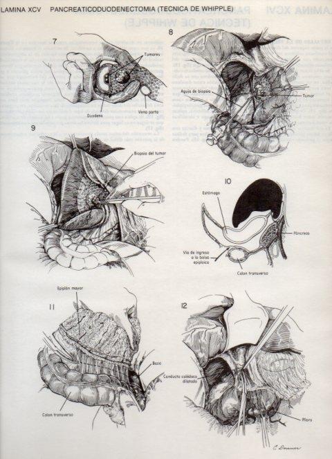 LAMINA V20156: Pancreaticoduodenectomia, tecnica de Whipple 2