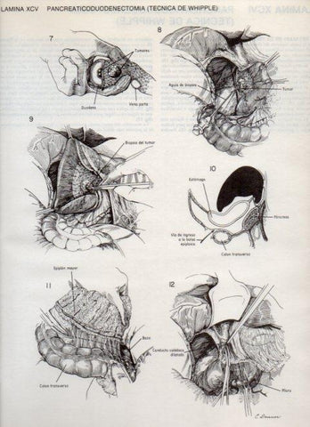 LAMINA V20156: Pancreaticoduodenectomia, tecnica de Whipple 2