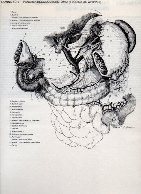 LAMINA V20155: Pancreaticoduodenectomia, tecnica de Whipple 1