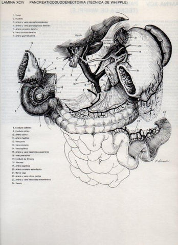 LAMINA V20155: Pancreaticoduodenectomia, tecnica de Whipple 1