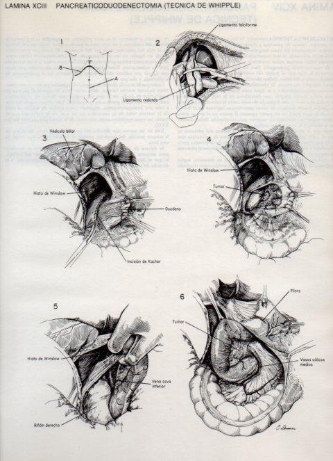 LAMINA V20154: Pancreaticoduodenectomia, tecnica de Whipple