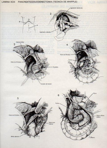LAMINA V20154: Pancreaticoduodenectomia, tecnica de Whipple