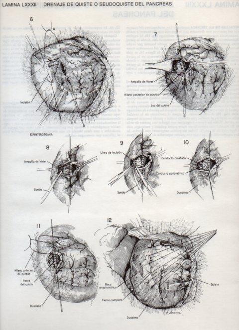 LAMINA V20151: Drenaje de quiste o seudoquiste del pancreas