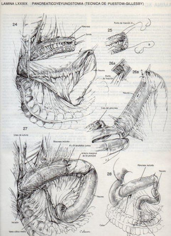 LAMINA V20149: Pancreaticoyeyunostomia, tecnica de Puestow-Gillesby 5