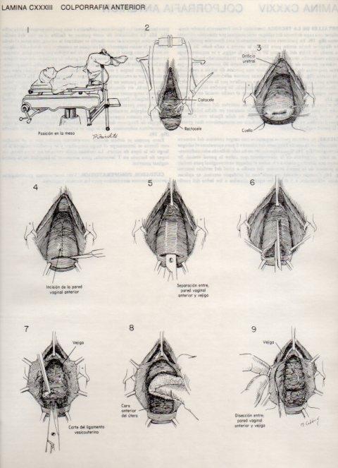 LAMINA V20194: Colporrafia anterior