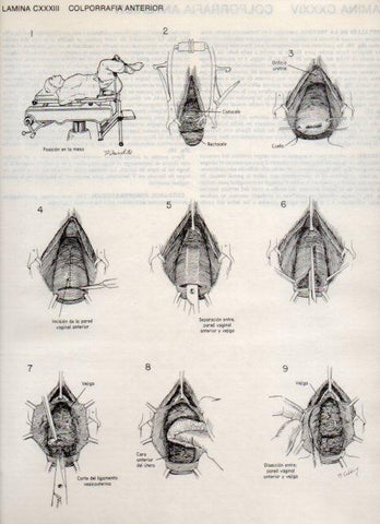 LAMINA V20194: Colporrafia anterior