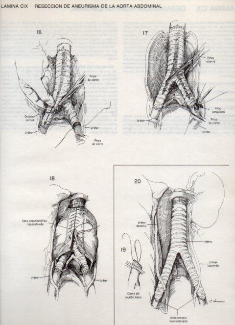 LAMINA V20170: Reseccion de aneurisma de la aorta abdominal 2