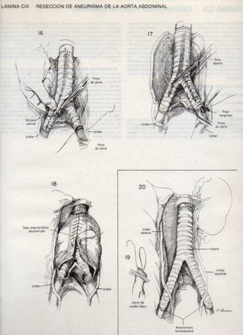 LAMINA V20170: Reseccion de aneurisma de la aorta abdominal 2