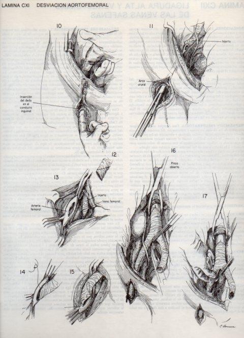 LAMINA V20172: Desviacion aortofemoral 1