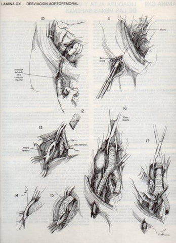 LAMINA V20172: Desviacion aortofemoral 1