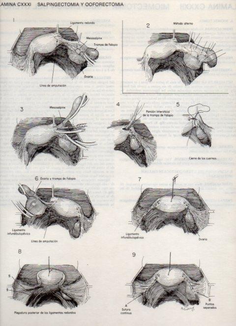 LAMINA V20192: Salpingectomia y Ooforectomia