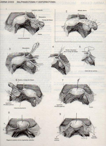 LAMINA V20192: Salpingectomia y Ooforectomia