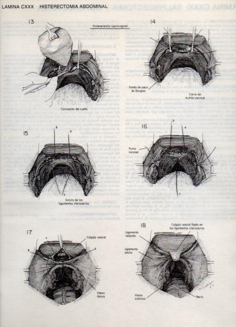 LAMINA V20191: Histerectomia abdominal