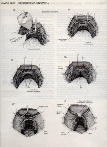 LAMINA V20191: Histerectomia abdominal