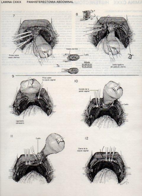LAMINA V20190: Panhisterectomia abdominal 1