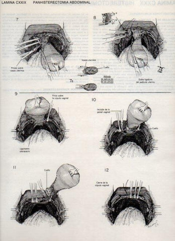 LAMINA V20190: Panhisterectomia abdominal 1