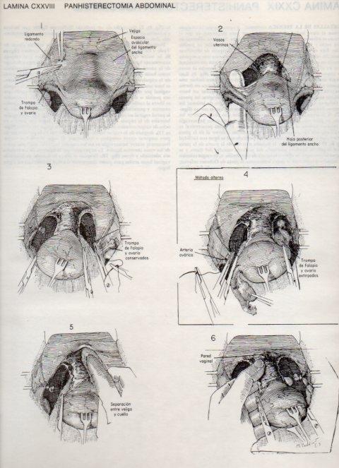 LAMINA V20189: Panhisterectomia abdominal