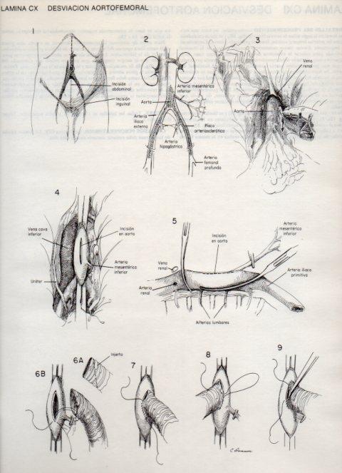 LAMINA V20171: Desviacion aortofemoral