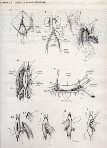 LAMINA V20171: Desviacion aortofemoral