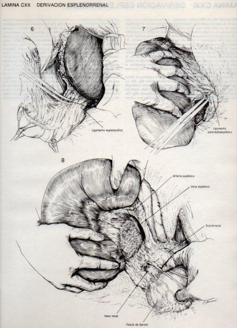 LAMINA V20181: Derivacion esplenorrenal 1