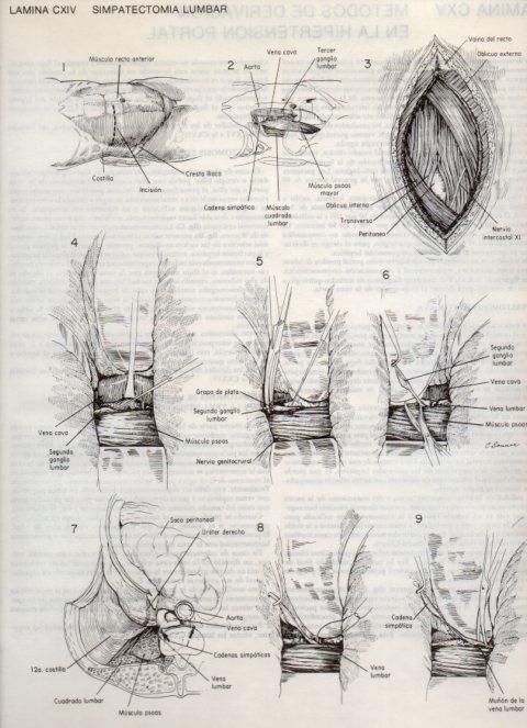 LAMINA V20175: Simpatectomia lumbar