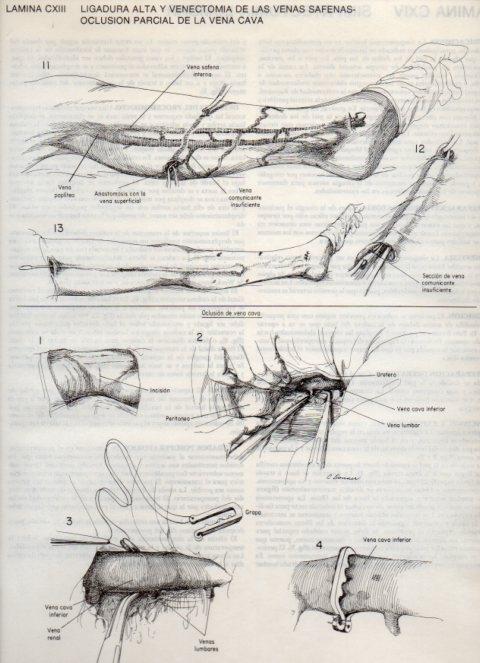 LAMINA V20174: Ligadura alta y venectomia de las venas safenas, oclusion parcial de la vena cava