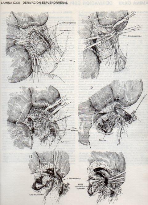LAMINA V20182: Derivacion esplenorrenal 2