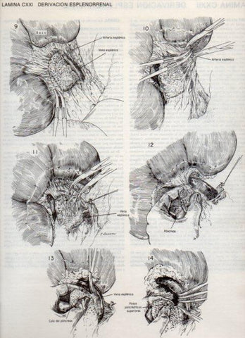 LAMINA V20182: Derivacion esplenorrenal 2