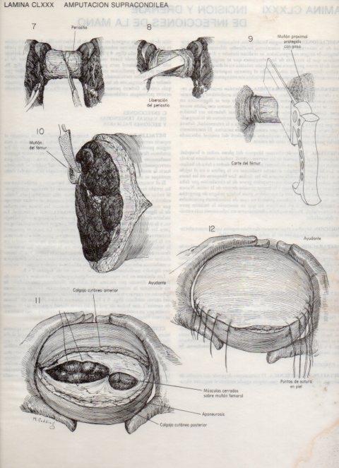 LAMINA V20241: Amputacion supracondilea 1
