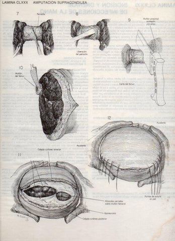 LAMINA V20241: Amputacion supracondilea 1