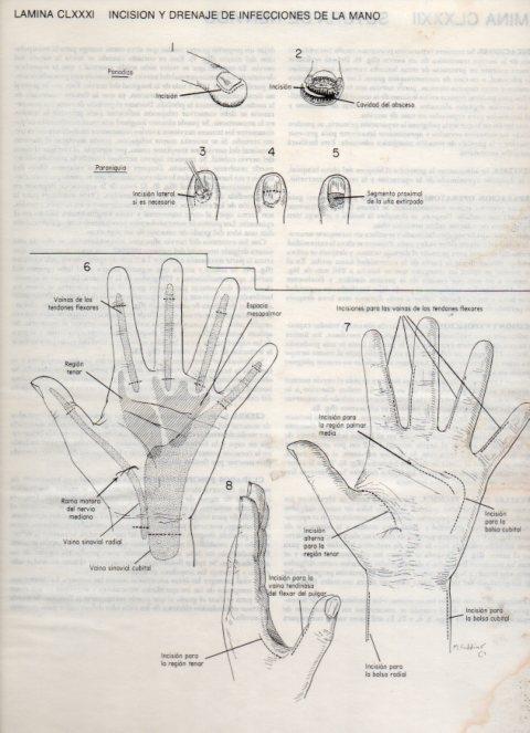 LAMINA V20242: Incision y drenaje de infecciones de la mano