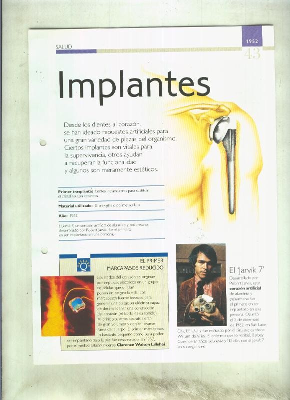 Implantes: son 4 paginas y 