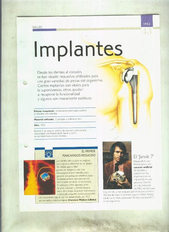Implantes: son 4 paginas y 
