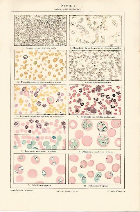LAMINA ESPASA 18421: Alteraciones patologicas de la sangre