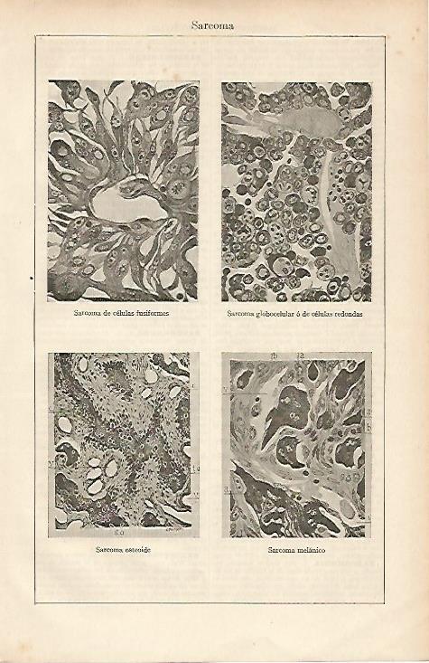 LAMINA ESPASA 19538: Sarcoma