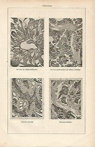 LAMINA ESPASA 19538: Sarcoma