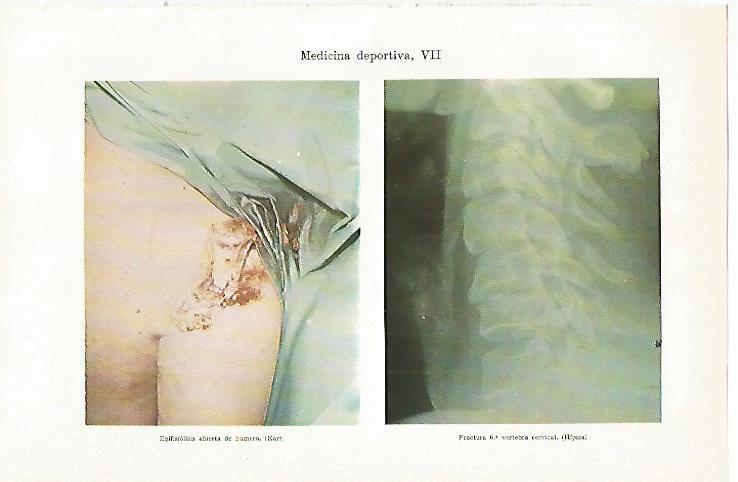 LAMINA ESPASA 13470: Epifisiolisis abierta de humero