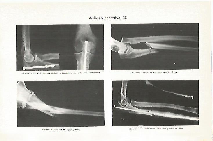 LAMINA ESPASA 13467: Fracturas en medicina deportiva