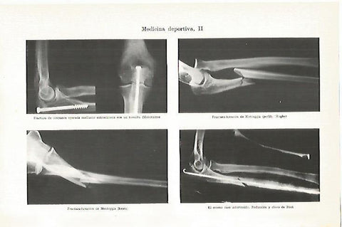 LAMINA ESPASA 13467: Fracturas en medicina deportiva